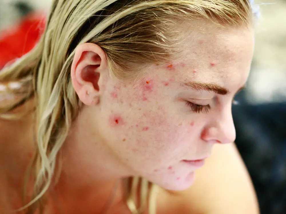 Acne na mulher adulta: tratamentos eficazes e o que realmente funciona